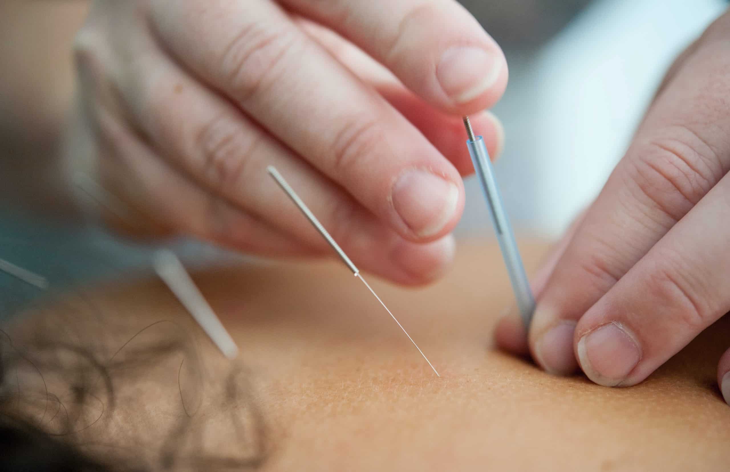 Acupuncture needles being applied to persons back